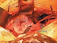 صورة توضيحية لـ استبدال مفصل الورك الكلي غير الإسمنتي