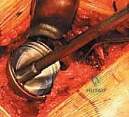 استبدال مفصل الورك الكلي غير الإسمنتي: دليل شامل للمرضى مع الأستاذ الدكتور محمد هطيف في صنعاء