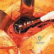 صورة توضيحية لـ استبدال مفصل الورك الكلي غير الإسمنتي: دليل شامل للمرضى مع الأستاذ الدكتور محمد هطيف في صنعاء