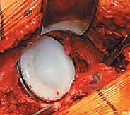 صورة توضيحية لـ استبدال مفصل الورك الكلي غير الإسمنتي: دليل شامل للمرضى مع الأستاذ الدكتور محمد هطيف في صنعاء