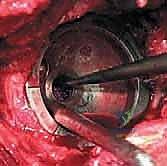 صورة توضيحية لـ استبدال مفصل الورك الكلي غير الإسمنتي: دليل شامل للمرضى مع الأستاذ الدكتور محمد هطيف في صنعاء