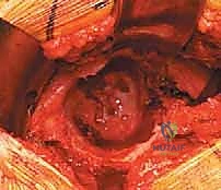 أعراض خشونة مفصل الورك