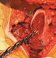 صورة طبية: استبدال مفصل الورك الكلي غير الإسمنتي: دليل شامل للمرضى مع الأستاذ الدكتور محمد هطيف في صنعاء