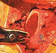 صورة توضيحية لـ استبدال مفصل الورك الكلي غير الإسمنتي: دليل شامل للمرضى مع الأستاذ الدكتور محمد هطيف في صنعاء