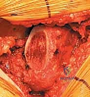 صورة طبية: استبدال مفصل الورك الكلي غير الإسمنتي: دليل شامل للمرضى مع الأستاذ الدكتور محمد هطيف في صنعاء