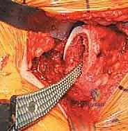 صورة توضيحية لـ استبدال مفصل الورك الكلي غير الإسمنتي: دليل شامل للمرضى مع الأستاذ الدكتور محمد هطيف في صنعاء