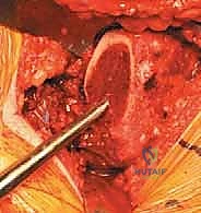 صورة توضيحية لـ استبدال مفصل الورك الكلي غير الإسمنتي: دليل شامل للمرضى مع الأستاذ الدكتور محمد هطيف في صنعاء