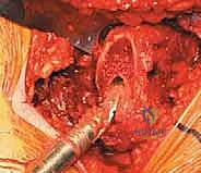 صورة طبية: استبدال مفصل الورك الكلي غير الإسمنتي: دليل شامل للمرضى مع الأستاذ الدكتور محمد هطيف في صنعاء