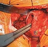 صورة طبية: استبدال مفصل الورك الكلي غير الإسمنتي: دليل شامل للمرضى مع الأستاذ الدكتور محمد هطيف في صنعاء