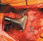 صورة طبية: استبدال مفصل الورك الكلي غير الإسمنتي: دليل شامل للمرضى مع الأستاذ الدكتور محمد هطيف في صنعاء