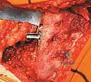 صورة طبية: استبدال مفصل الورك الكلي غير الإسمنتي: دليل شامل للمرضى مع الأستاذ الدكتور محمد هطيف في صنعاء