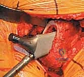 صورة طبية: استبدال مفصل الورك الكلي غير الإسمنتي: دليل شامل للمرضى مع الأستاذ الدكتور محمد هطيف في صنعاء