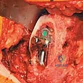 صورة طبية: استبدال مفصل الورك الكلي غير الإسمنتي: دليل شامل للمرضى مع الأستاذ الدكتور محمد هطيف في صنعاء