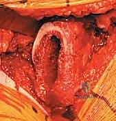 صورة طبية: استبدال مفصل الورك الكلي غير الإسمنتي: دليل شامل للمرضى مع الأستاذ الدكتور محمد هطيف في صنعاء