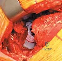 صورة طبية: استبدال مفصل الورك الكلي غير الإسمنتي: دليل شامل للمرضى مع الأستاذ الدكتور محمد هطيف في صنعاء