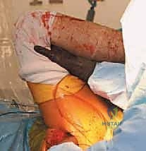 Illustration of soft tissue tension - Dr. Mohammed Hutaif