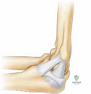 صورة توضيحية لتشريح مفصل الكوع المتأثر بالإجهاد الانقلابي