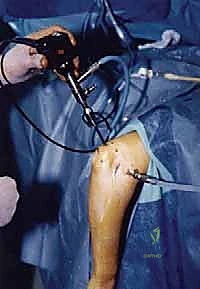 صورة توضيحية للنتوءات العظمية والانحشار في متلازمة إجهاد الكوع