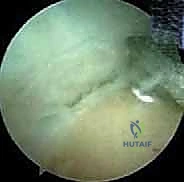 صورة توضيحية لإدخال المنظار وتقييم المفصل من الداخل