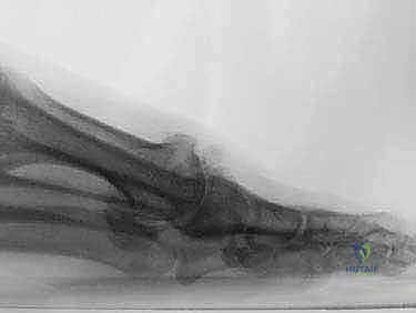 تثبيت النسيج الحيوي فوق السطح العظمي