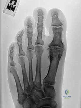 Illustration of capsular interpositional arthroplasty - Dr. Mohammed Hutaif