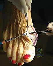 تأثير الميكانيكا الحيوية الخاطئة على مفصل الإبهام