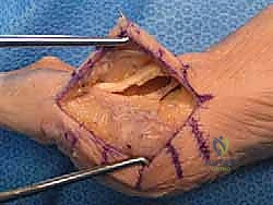 جراحة تبديل المفصل بالكبسولة لإبهام القدم المتصلب: استعادة الحركة بلا ألم مع الأستاذ الدكتور محمد هطيف