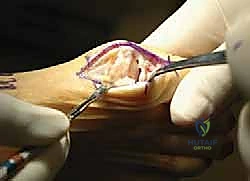 مقارنة بين الخيارات الجراحية المختلفة لمفصل الإبهام