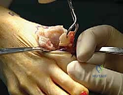 تعديل الأحذية كخطوة أولى في العلاج التحفظي