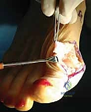 تحضير السديلة النسيجية من الكبسولة المفصلية