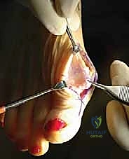 تشريح المفصل المشطي السلامي الأول وتأثير الفصال العظمي