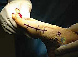 تطور النتوءات العظمية في إبهام القدم المتصلب