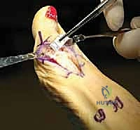 إغلاق الجرح وتطبيق الضمادات الطبية