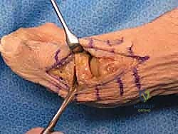 المرونة العالية بعد جراحة تبديل المفصل بالكبسولة