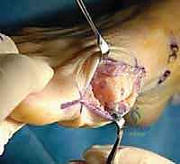 صورة توضيحية لـ جراحة تبديل المفصل بالكبسولة لإبهام القدم المتصلب: استعادة الحركة بلا ألم مع الأستاذ الدكتور محمد هطيف