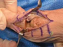 إجراء الشق الجراحي وكشف المفصل المتضرر