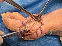 صورة توضيحية لـ جراحة تبديل المفصل بالكبسولة لإبهام القدم المتصلب: استعادة الحركة بلا ألم مع الأستاذ الدكتور محمد هطيف