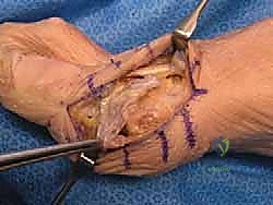 استئصال النتوءات العظمية وتشكيل رأس عظمة المشط