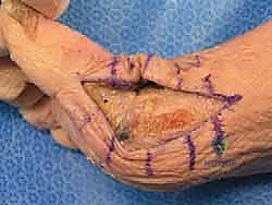 صورة توضيحية لـ جراحة تبديل المفصل بالكبسولة لإبهام القدم المتصلب: استعادة الحركة بلا ألم مع الأستاذ الدكتور محمد هطيف