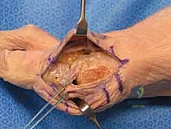 تصوير شعاعي يوضح مراحل متقدمة من إبهام القدم المتصلب