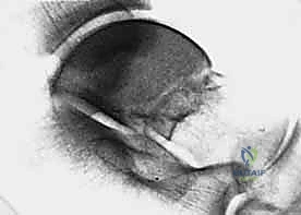 تخطيط جراحي لكسر القنزعة