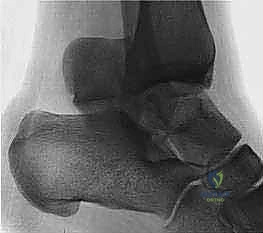Open Reduction & Internal Fixation of the Talus: An Operative Masterclass