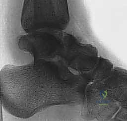 تشريح دقيق لكسر عظم الكاحل