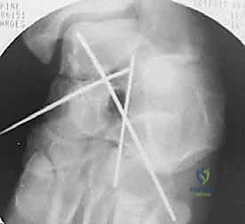 صورة طبية: كسر عظم الكاحل: الرد المفتوح والتثبيت الداخلي - دليل شامل من الأستاذ الدكتور محمد هطيف في صنعاء