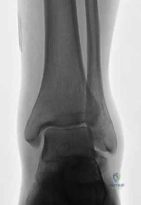 صورة طبية: كسر عظم الكاحل: الرد المفتوح والتثبيت الداخلي - دليل شامل من الأستاذ الدكتور محمد هطيف في صنعاء