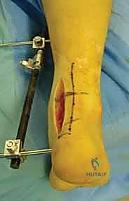 كسر في النتوء الجانبي