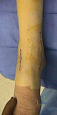 تروية دموية لعظم الكاحل