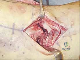 أعراض وتورم الكاحل