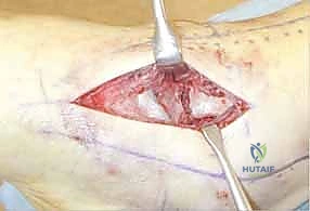 آلية الإصابة بكسر الكاحل