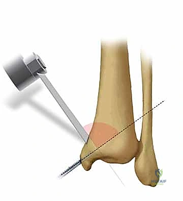 أشعة سينية لكسر الكاحل